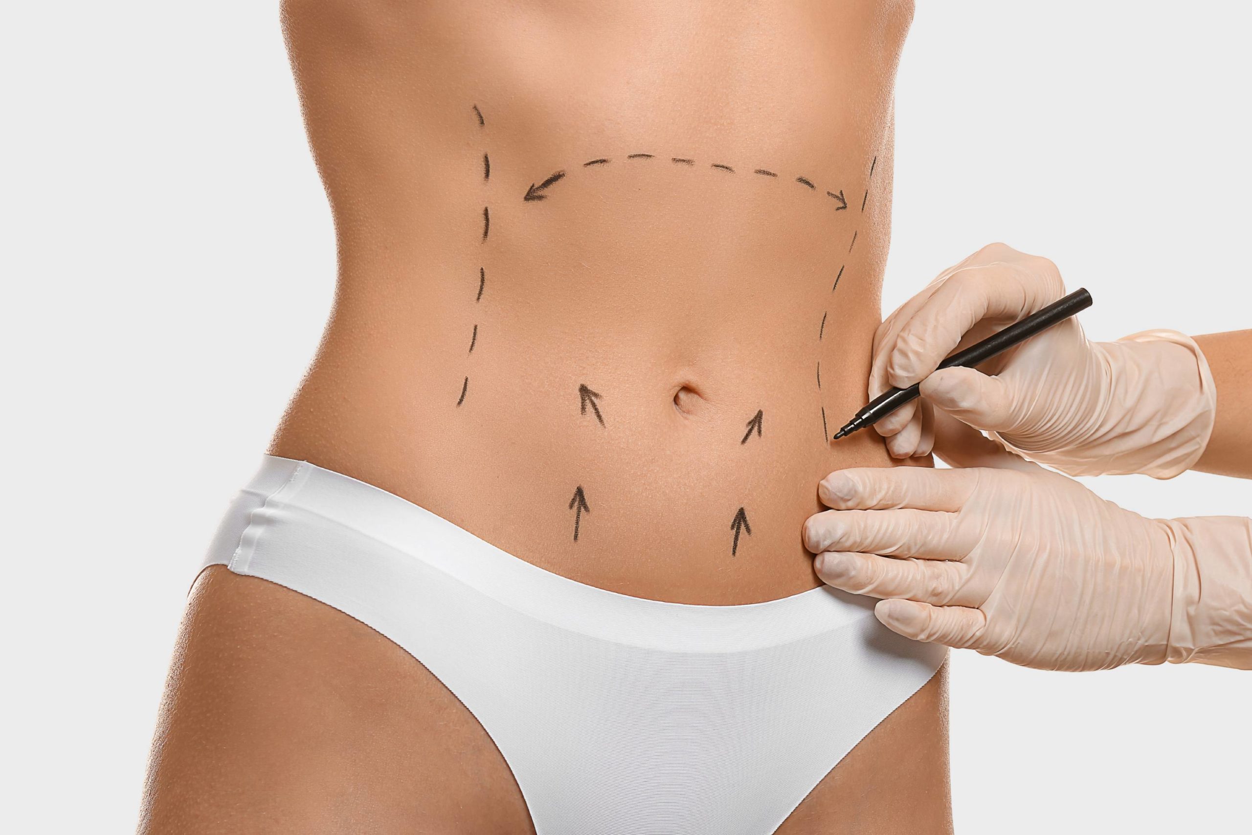 How Much Does Fat Transfer Cost