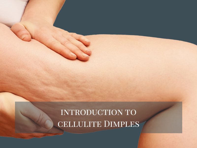 Introduction to Cellulite Dimples
