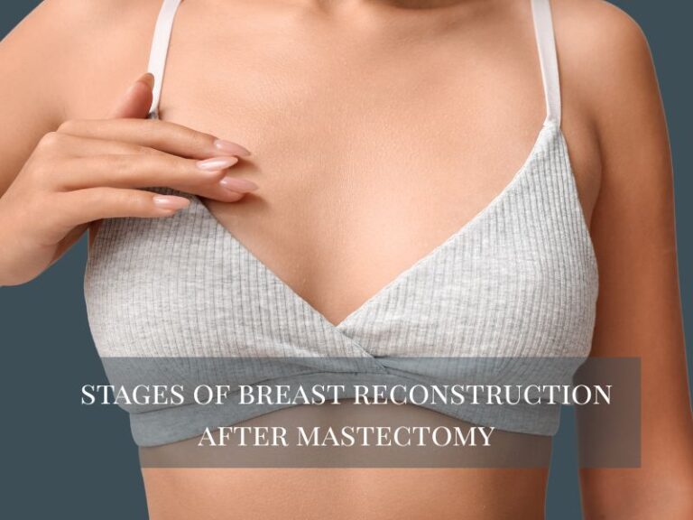 Stages of Breast Reconstruction After Mastectomy