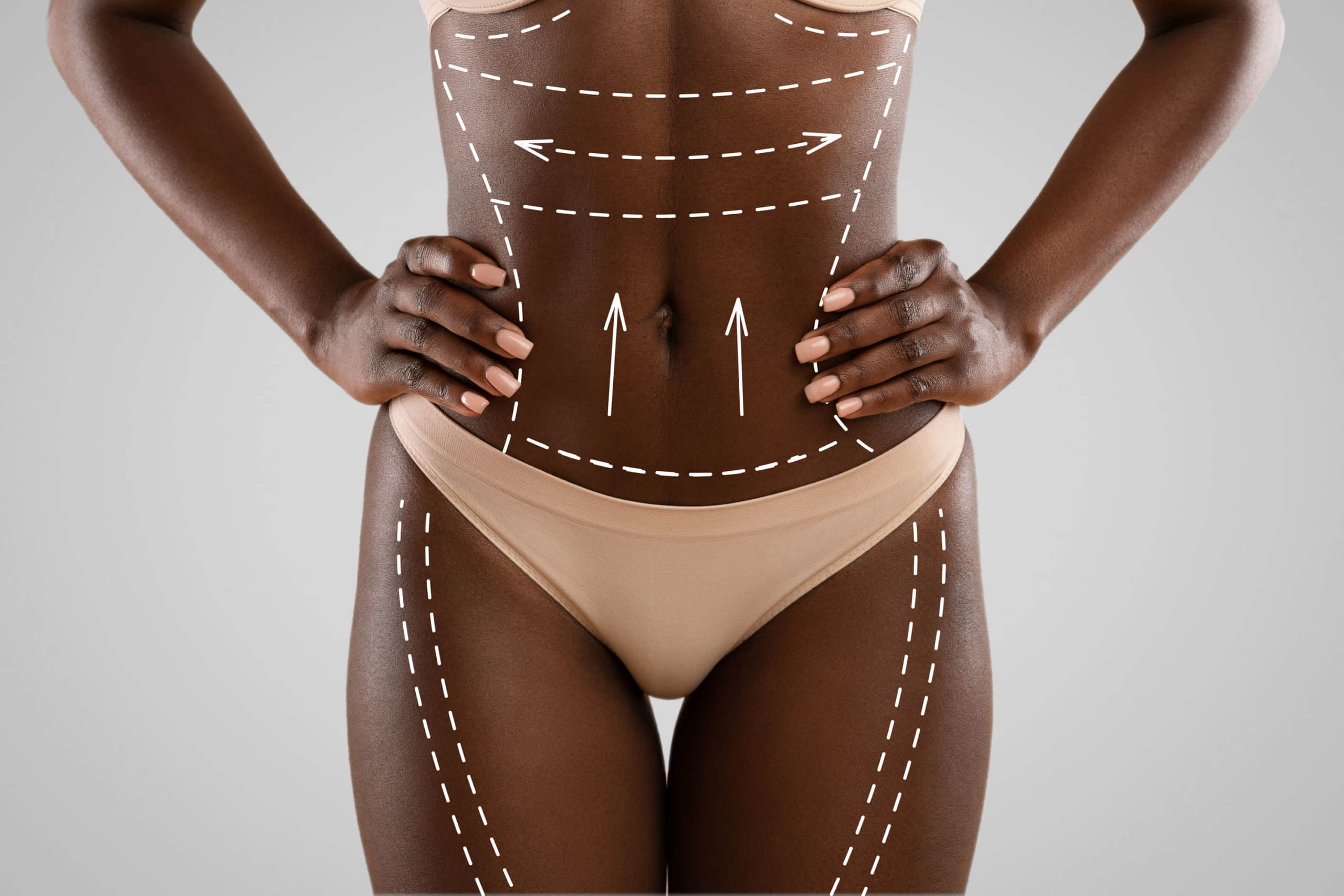 Tummy Tuck or Liposuction