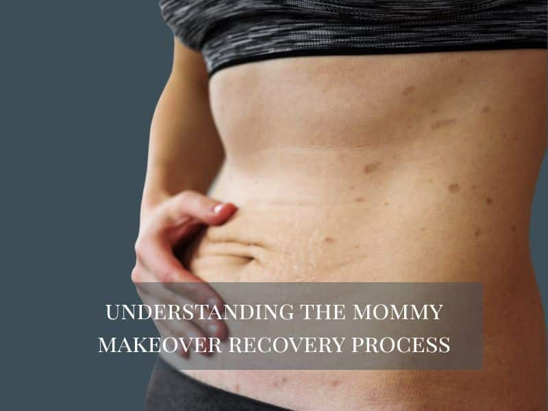 Understanding the Mommy Makeover Recovery Process