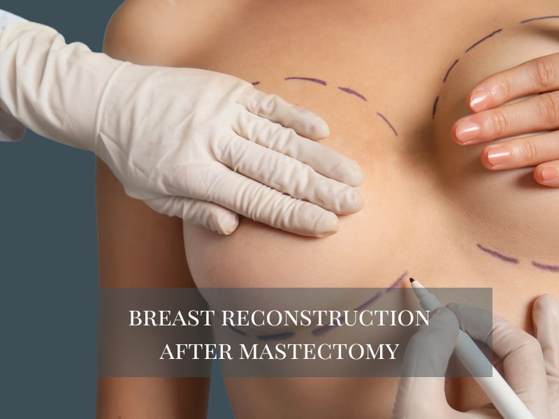 breast reconstruction after mastectomy