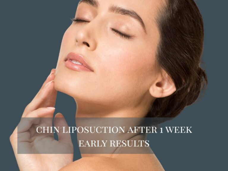 Chin Liposuction after 1 week early results
