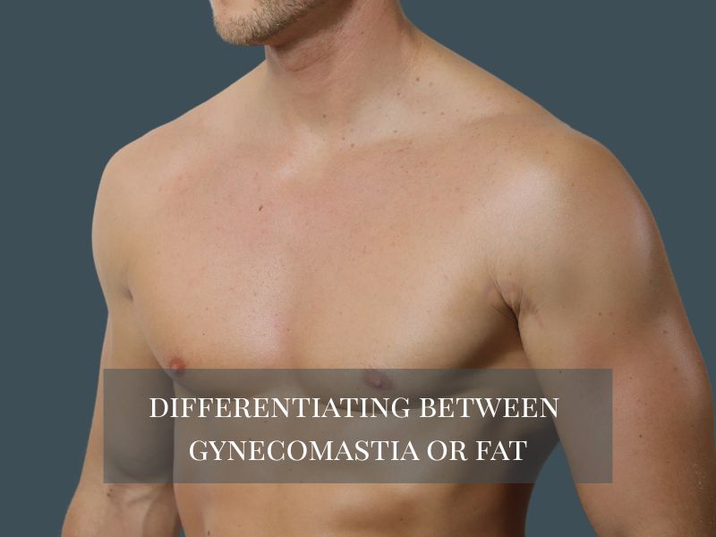 differentiating between gynecomastia or fat