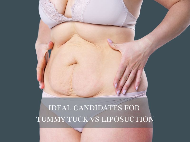 ideal candidates for tummy tuck vs liposuction