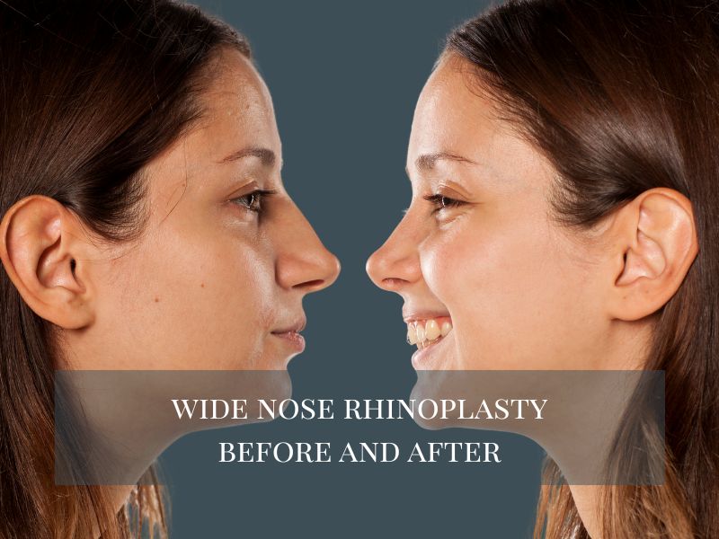 Wide Nose Rhinoplasty Before and After